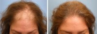 female-hair-restoration