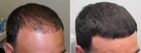 v71mm53dpt9rxepp.D.0.Hair-Loss-Treatment